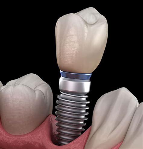 affordable dental implants bay area